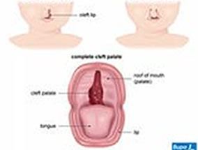 GELİŞİMSEL DİL VE KONUŞMA BOZUKLUĞU